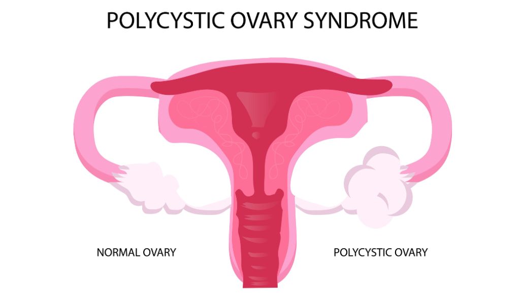 Infertility in women with PCOS